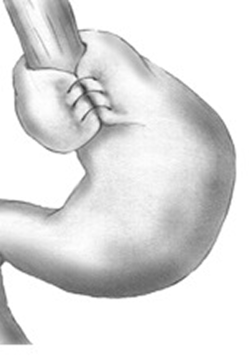 Imagen de funduplicatura laparoscópica